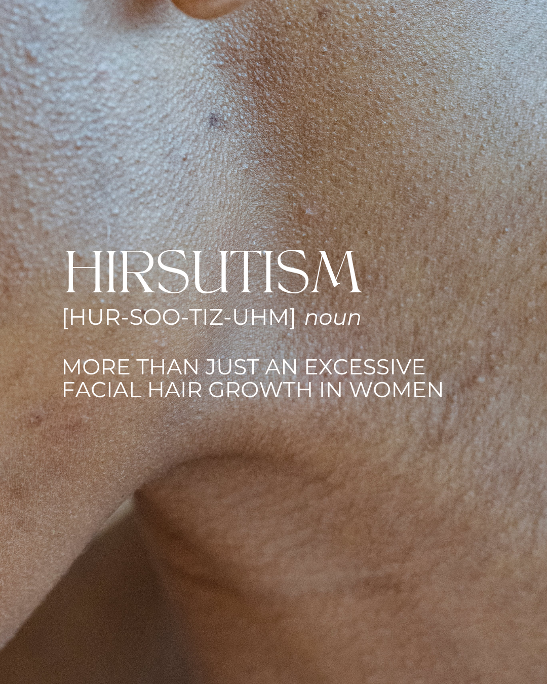 What is HIRSUTISM